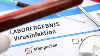 Deutschland reagiert mit einer neuen Quarantäneregelung auf die Fälle von Affenpocken.
