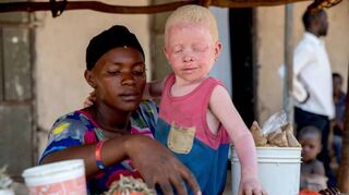 In ihrer Heimat Uganda fällt die kleine Aisha sofort auf. Sie ist das Kind schwarzer Eltern, doch ihre Haut ist weiß. Die Vierjährige hat Albinismus.