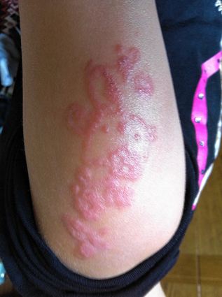 <p>Auf ein Henna-Tattoo mit gefährlichem Inhaltsstoff reagiert die Haut häufig mit Jucken und Brennen. Zurück bleiben Narben und eine Allergie.</p>