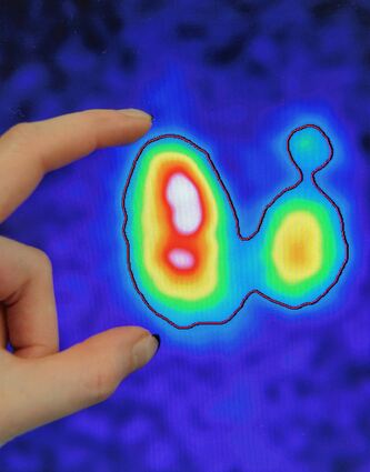<p>Das Bild einer erkrankten Schilddrüse: In Deutschland sind zahlreiche Patienten von Fehlfunktionen des kleinen Organs betroffen.</p>
